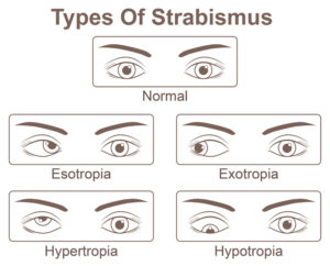 Les patchs oculaires sont-ils bons pour les yeux ?
